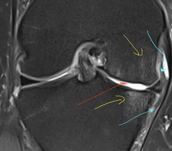IRM montrant des chondropathies stade IV fémorotibiales internes avec oedème osseus sous chondral