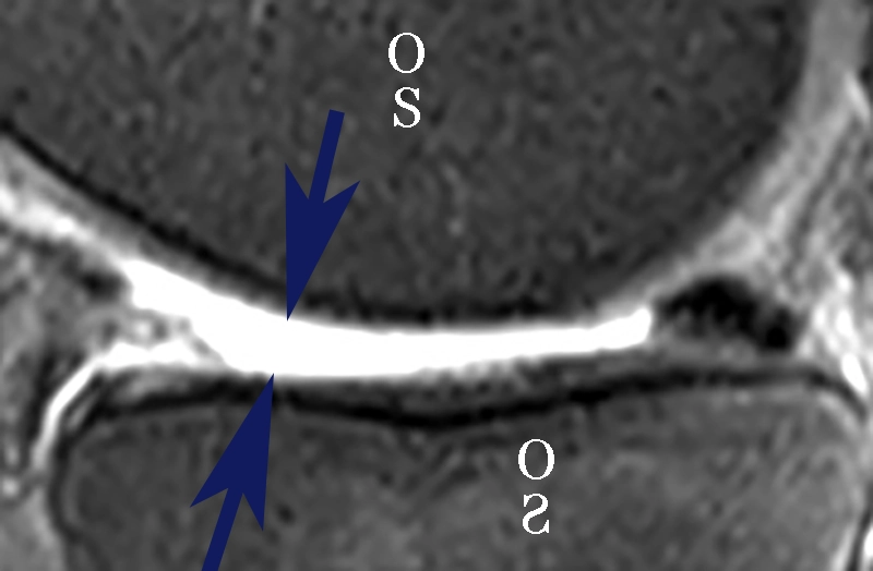 Coupe IRM cartilage usé : chondropathie