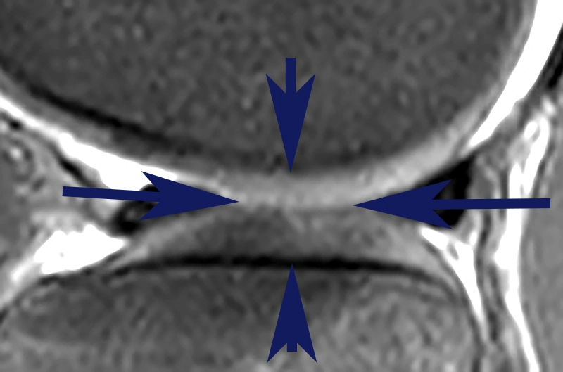 Coupe irm cartilage d'épaisseur normale : sans arthrose