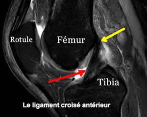 IRM de profil montrant un ligament croisé antérieur normal