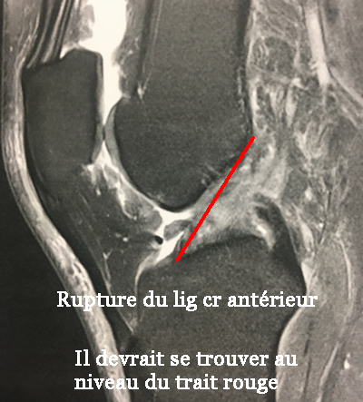 IRM d'une rupture du ligament croisé antérieur