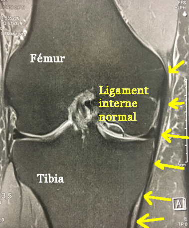 Irm d'un ligament interne normal du genou