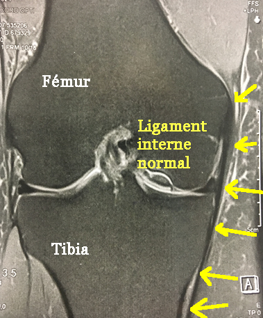 le ligament interne est collé au fémur et au tibia Irm d'un ligament interne normal du genou