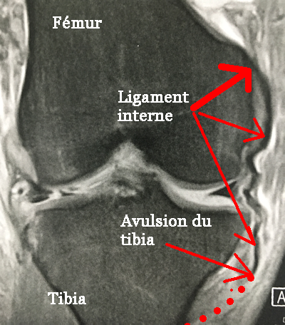Irm d'une desinsertion basse (rupture) du  ligament latéral interne du genou