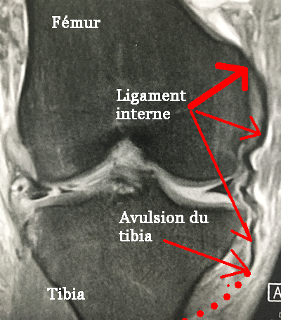 Irm d'une desinsertion basse (rupture) du ligament latéral interne du genou