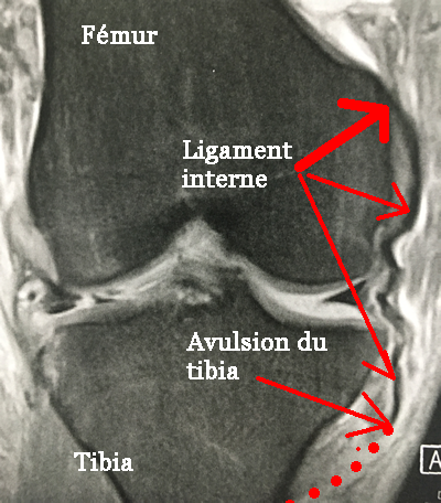 Le ligament collatéral interne