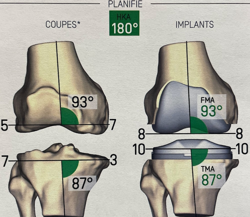 Planification du positionnement des pièces pour reproduire le genou d'origine