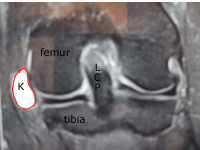 IRM montrant un kyste poplité étendu