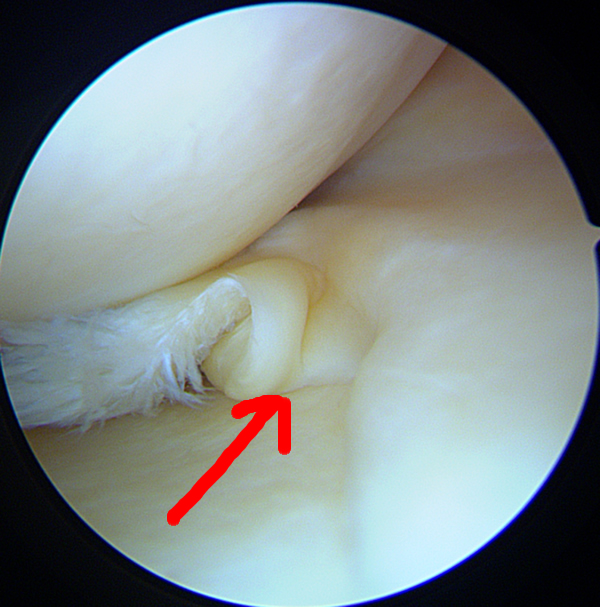 Languette méniscale