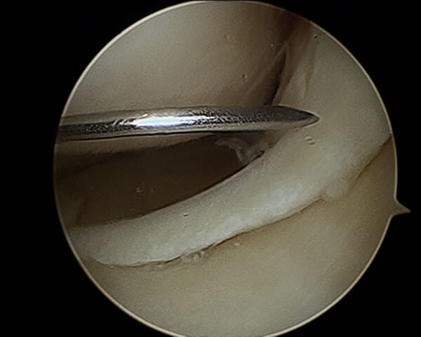Languette méniscale vue sous arthroscopie