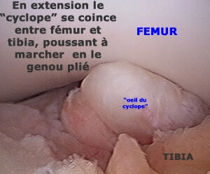 Fragment du ligament croisé antérieur rompu qui vient s'interposer entre fémur et tibia, empêchant l'extension complète.
