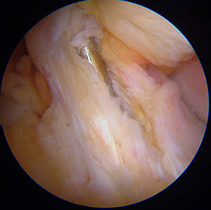 Broche insérée dans le tibia, sous arthroscopie, pour la création du tunnel tibial