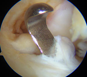 Introduction du mesureur dans le tunnel tibial