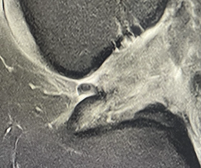 Rupture du Ligament croisé antérieur  sur une IRM