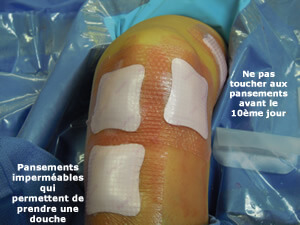 Pansements après opération du ligament