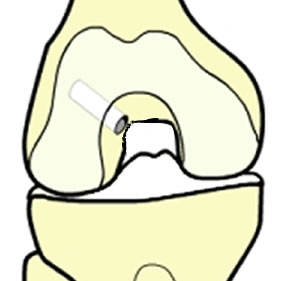 Représentation du tunnel fémoral borgne