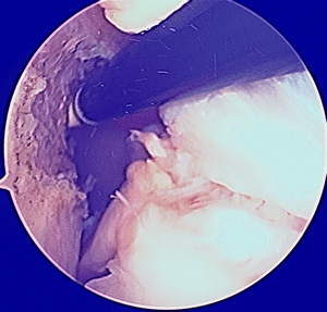 L'insertion du LCA est en arrière