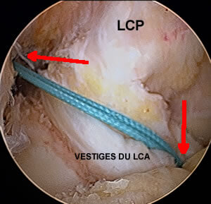 Trajet de la future greffe du LCA entre tibia et fémur