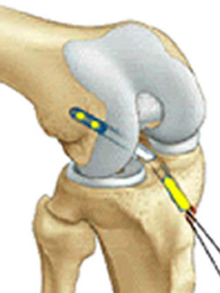 dessin d'une ligamentoplastie du ligament croisé antérieur