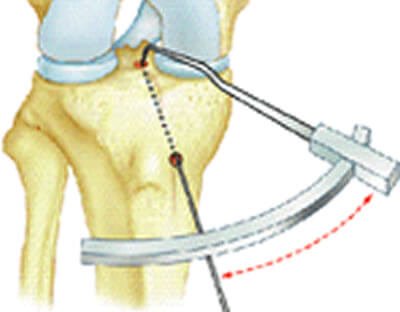 Dessin montrant le principe de l'utilisation du viseur tibial