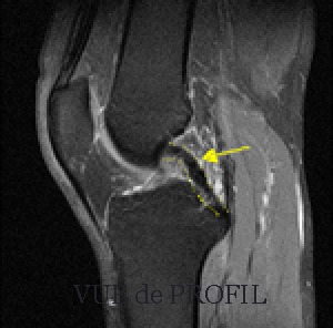 Ligament croisé postérieur normal sur une IRM
