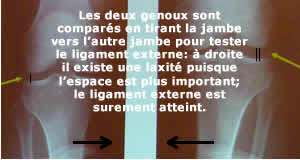 Laxité externe : testing radiologique