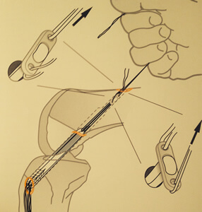 Fixation de la greffe par un endobutton fémoral