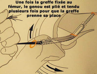 La mobilisation du genou permet d'apprécier l'isométrie de la greffe