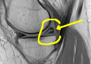 IRM : lésion méniscale interne dégénérative