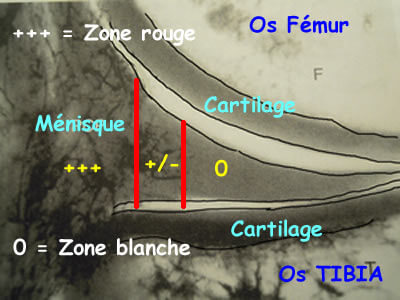 Coupe d'IRM de profil du genou