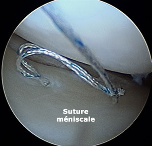 suture meniscale sous arthroscopie