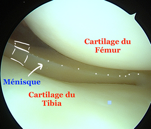 vue d'un ménisque normal sous arthroscopie