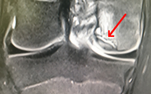 IRM d'une ostéochondrite du condyle interne