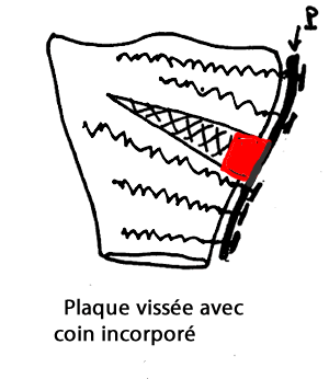 Fixation par une plaque vissée d'une ostéotomie de valgisation par ouverture interne