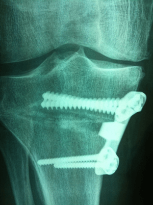 Radiographie d’une ostéotomie tibiale d’ouverture interne
