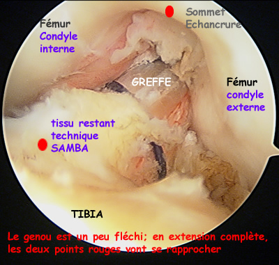 Image arthroscopique du LCA reconstruit selon la technique habituelle (SAMBA)