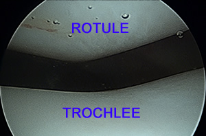 Arthroscopie : cartilage normal de la rotule