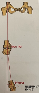 Planification pour prothèse de genou : gonométrie préopératoire 