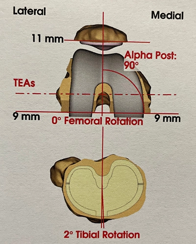 Planification pour prothèse de genou : positionnement des pièces en axial