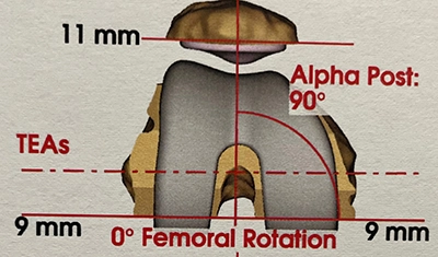 Planification préopératoire de la position voulue  de la pièce posée sur le fémur