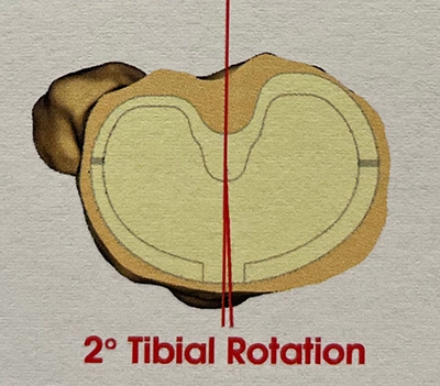 Planification préopératoire de la position voulue  de la pièce posée sur le tibia