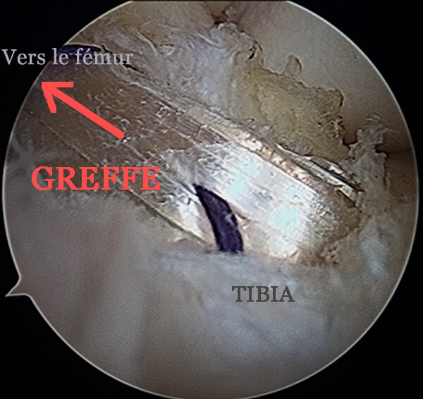Vue arthroscopique de la greffe du  ligament croisé antérieur