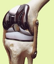 Modèle en plastique d'un genou sur lequel sont posées les deux pièces fémorale et tibiale d'une prothèse totale de genou.