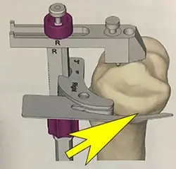 Exemple de guide de coupe osseuse pour le tibia