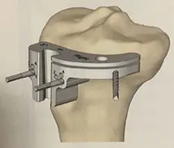 Guide de coupe classique pour le tibia