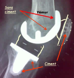 prothèse totale de genou cimentée au niveau du tibia et avec médaillon rotulien