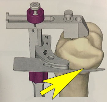 Guide de coupe osseuse pour le tibia