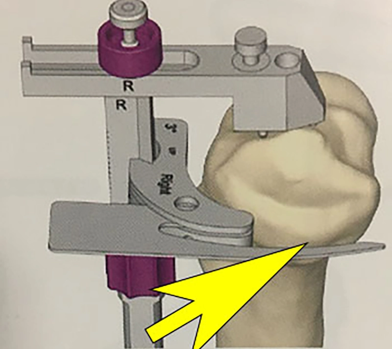 Guide de coupe de série pour le tibia