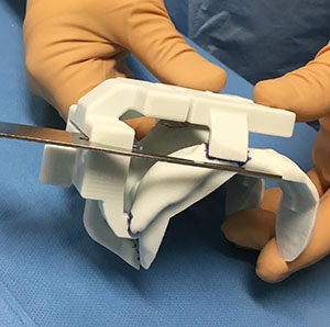 La faux, ici sur le modèle en plastique,  permet au chirurgien, pendant l'opération, de visualiser l'épaisseur à enlever 