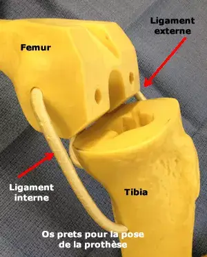 Coupes osseuses pour la pose d'une prothèse de genou